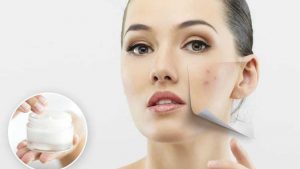Krim Penghilang Bekas Jerawat Terbaik liputantimes.com