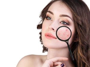 cara menghilangkan bekas jerawat dan flek hitam