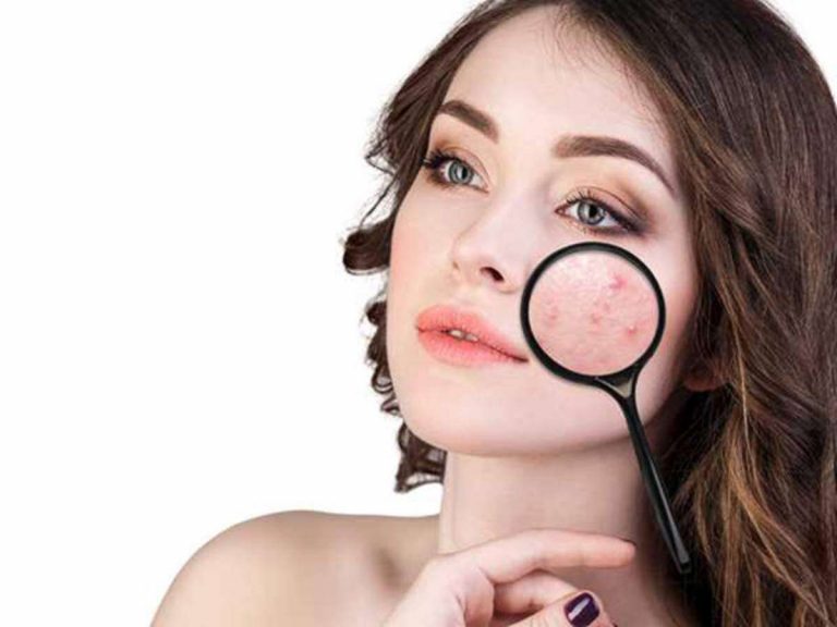 cara menghilangkan bekas jerawat dan flek hitam