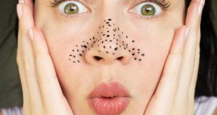 Cara menghilangkan blackhead