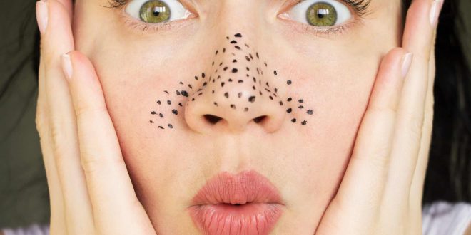 Cara menghilangkan blackhead