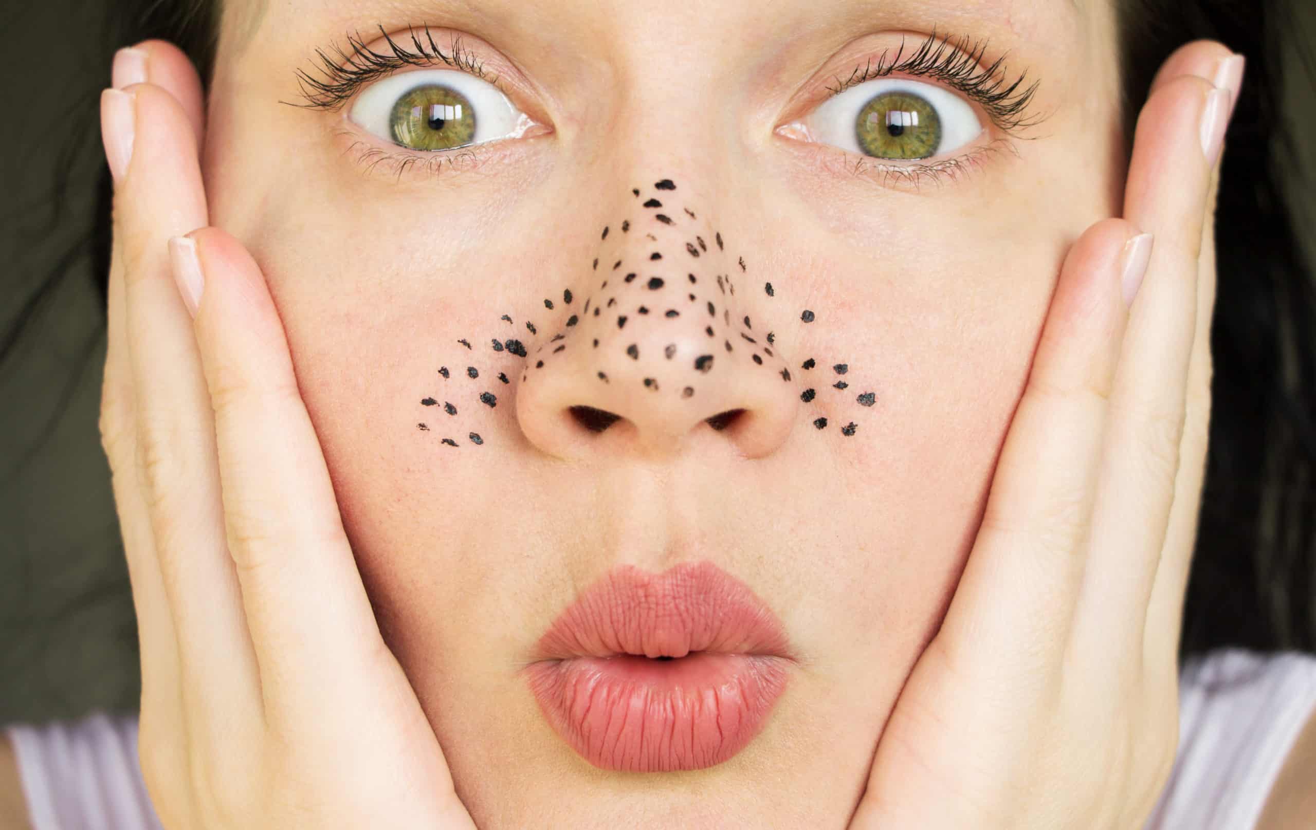 Cara menghilangkan blackhead