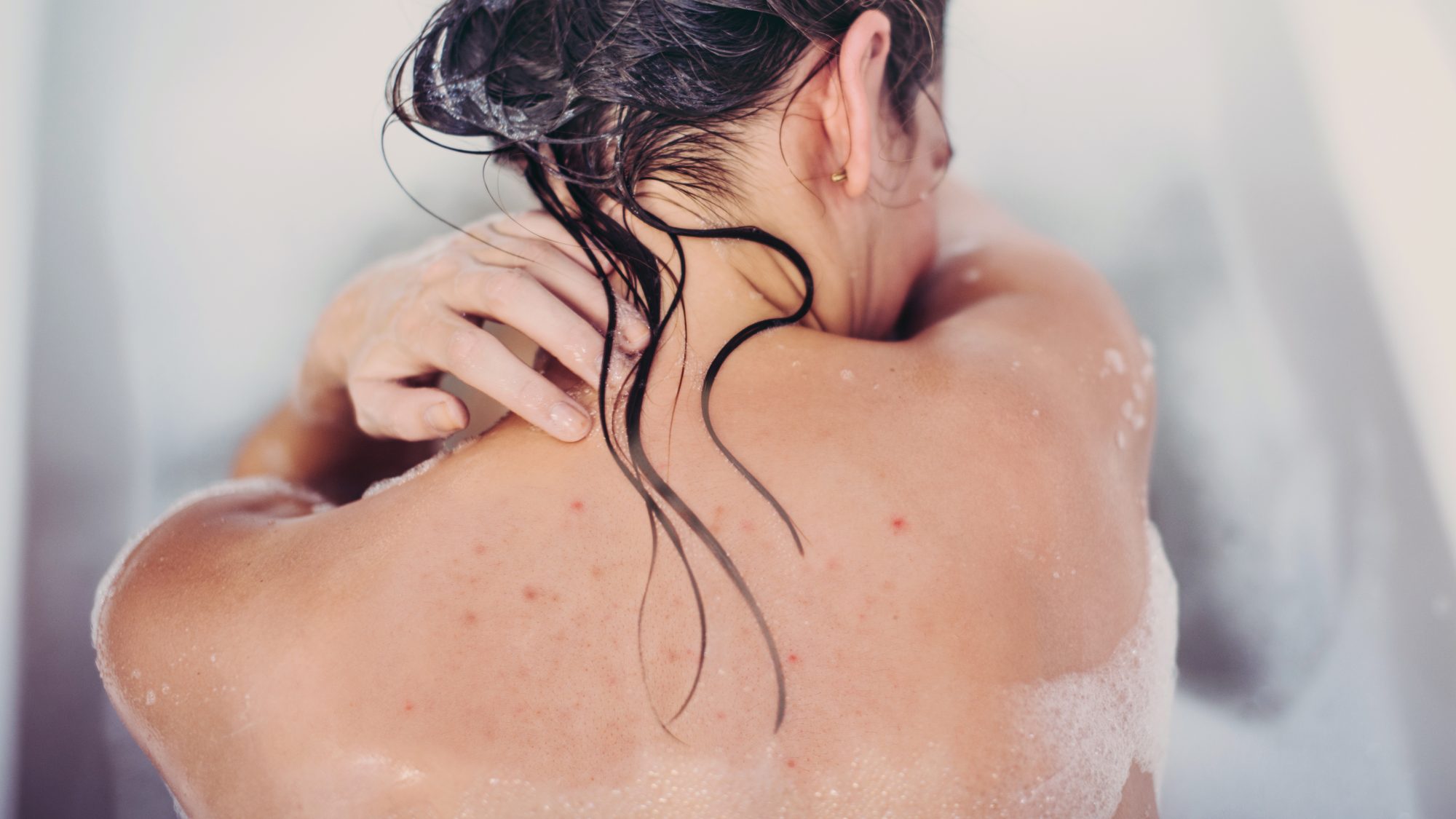 cara menghilangkan jerawat punggung